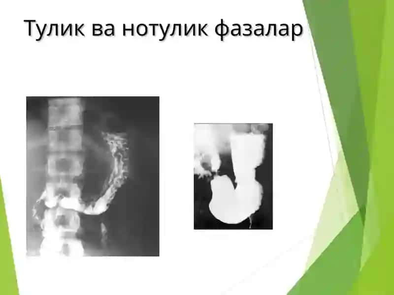 OSHQOZON ICHAK TIZIMI KASALLIKLARI 4