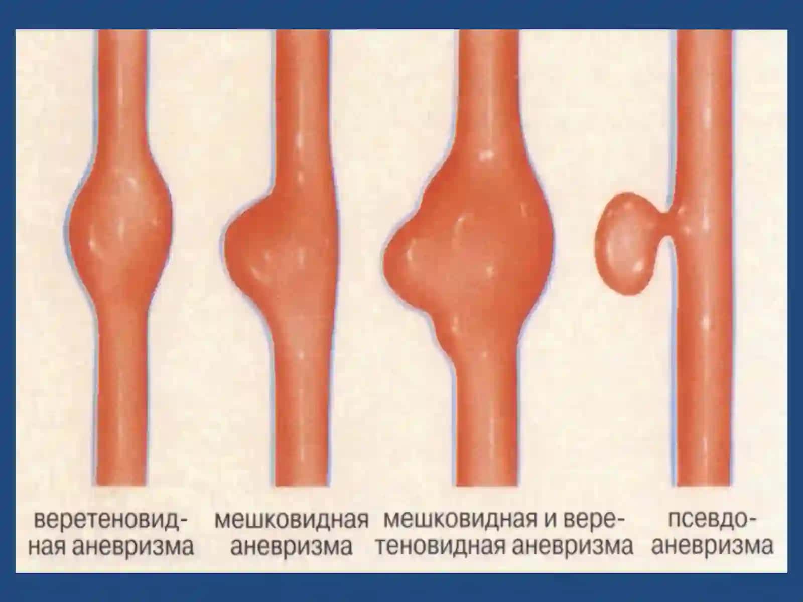 Сосудистая патология головного мозга 4