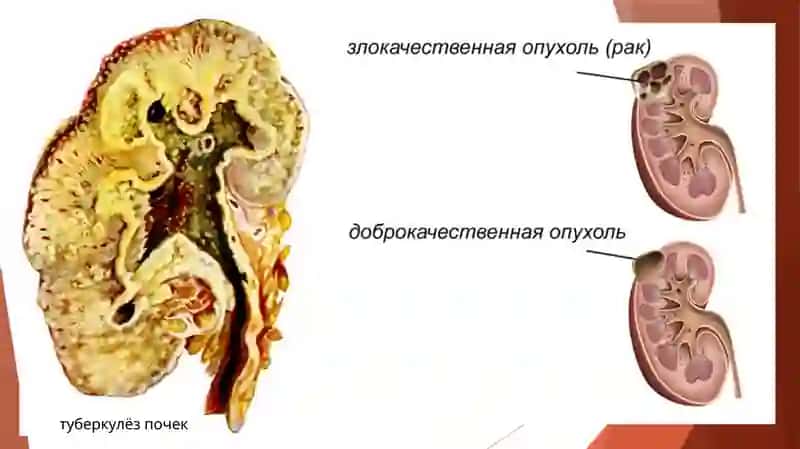 Бронзовая болезньили Болезнь Аддисона 4