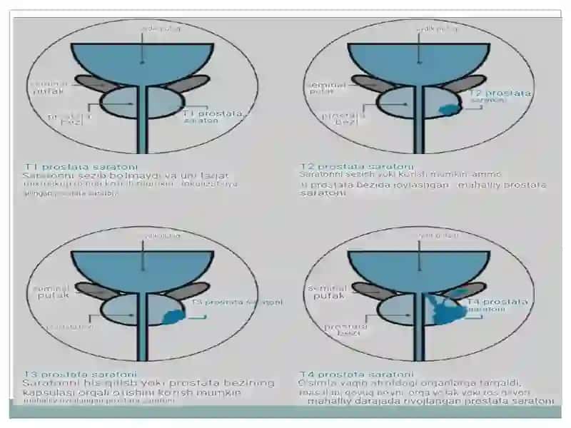 Prostatabezio’smalari 4