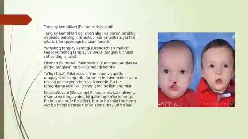 Tug'ma lab va tanglay kemtiklari 4