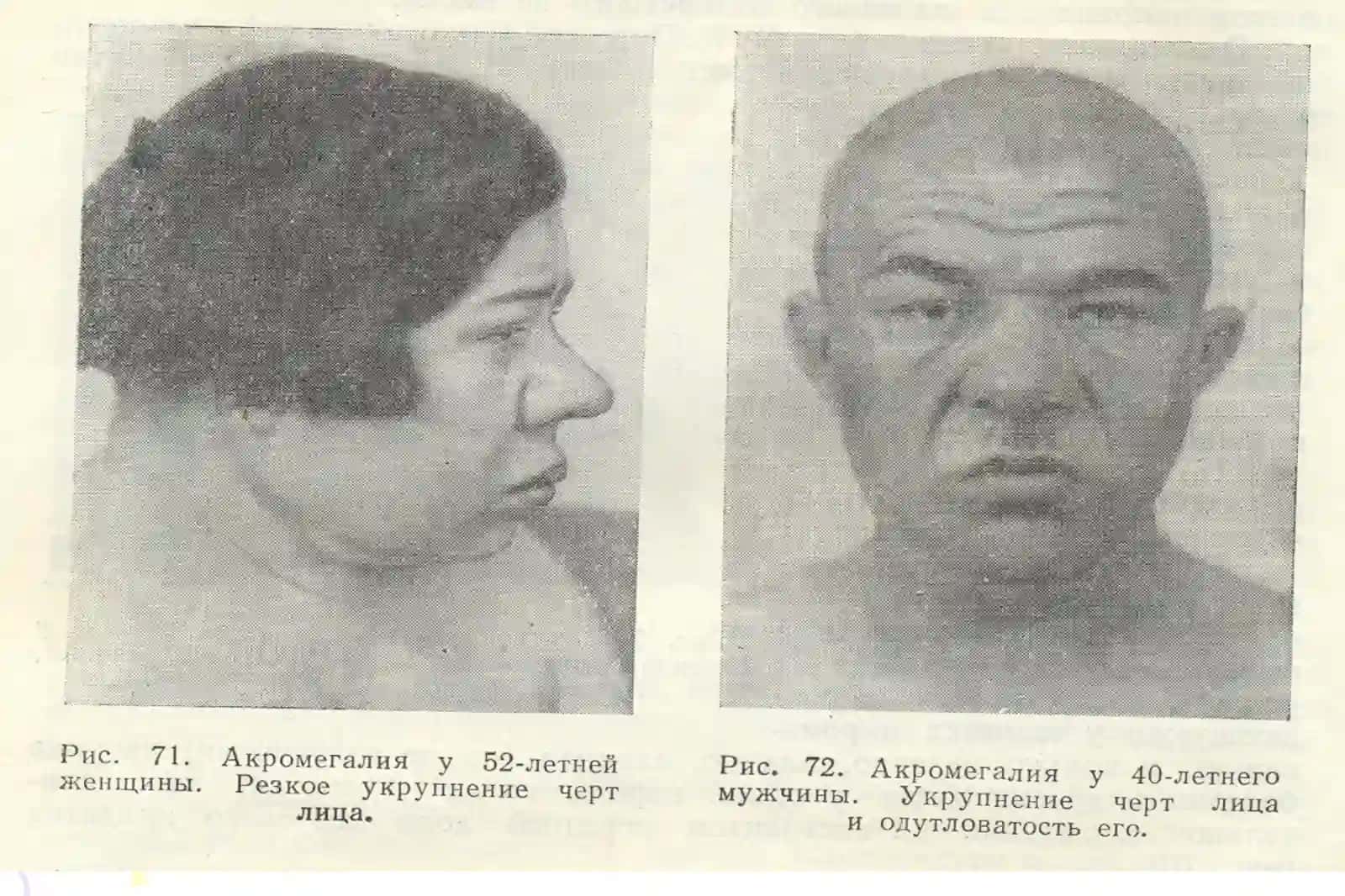 АКРОМЕГАЛИЯ 4