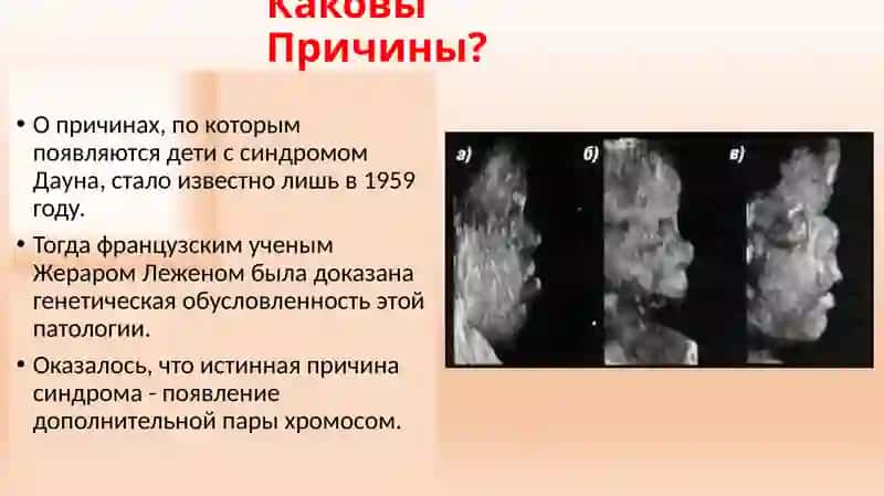 Биохимические и генетические факторы в развитии синдрома Дауна 4