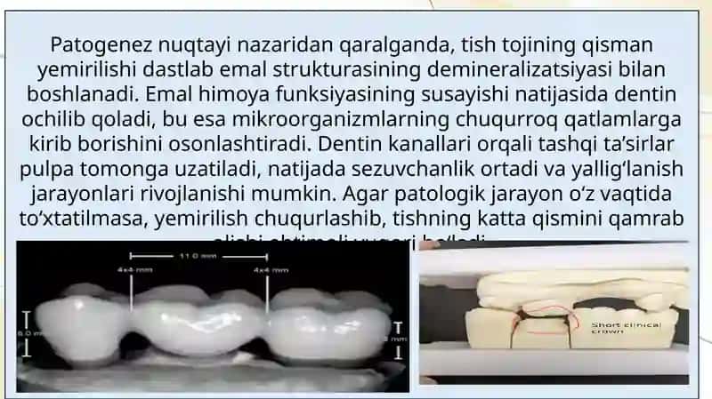 Tish tojining qisman yemirilishi. Qattiq to' qimalarning shikastlanish tasnifi. Etiologiyasi, patogenezi, klinik ko'rinishi.Tish nuqsonlarining xalqaro tasnifi. Tishlarning anatomık shaklini tiklaydigan protez turlari.Qistirmalar tasnifi. 4