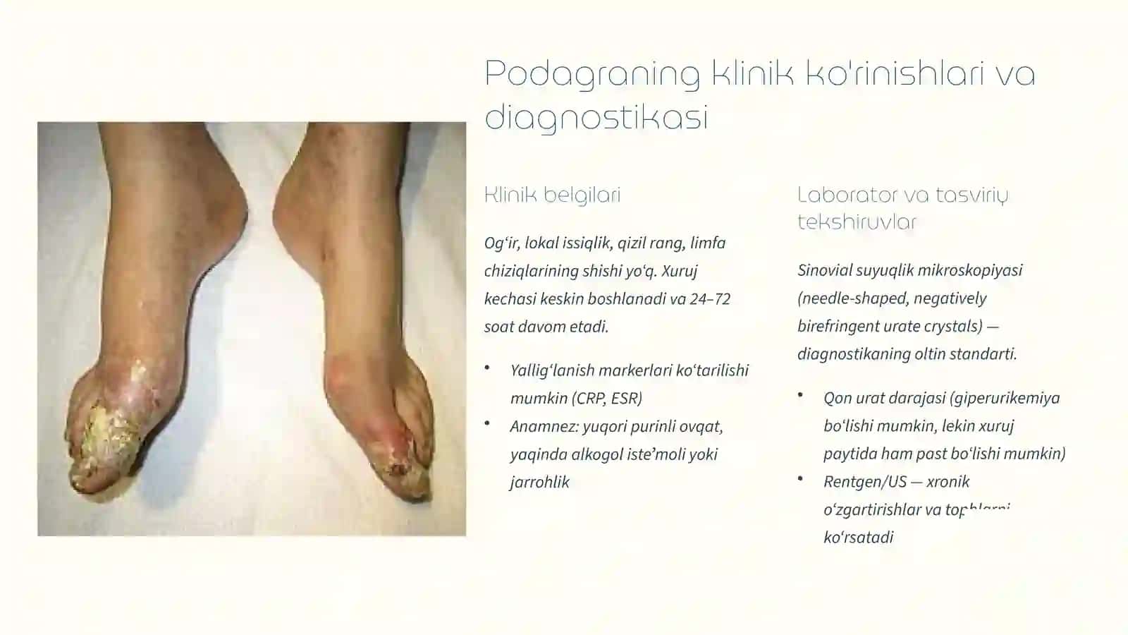 Giperurikemiya va podagra: Diagnostika va Zamonaviy Davolash Usullari 4