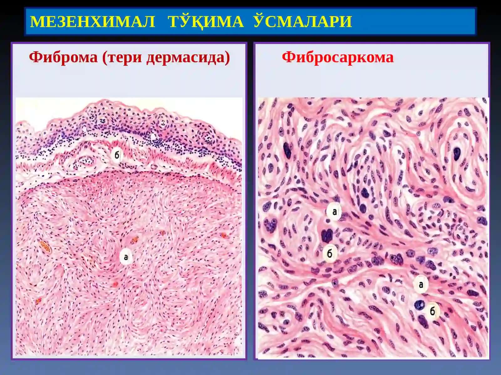 Мезенхимал тўқима ўсмалари 4