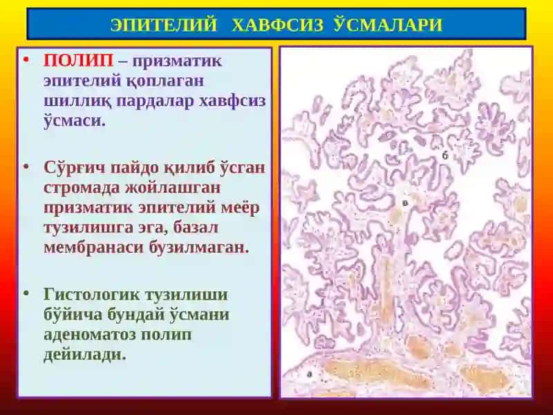 ПАТОЛОГИК АНАТОМИЯ “Ўсмалар. Мезенхимал ўсмалар” 4
