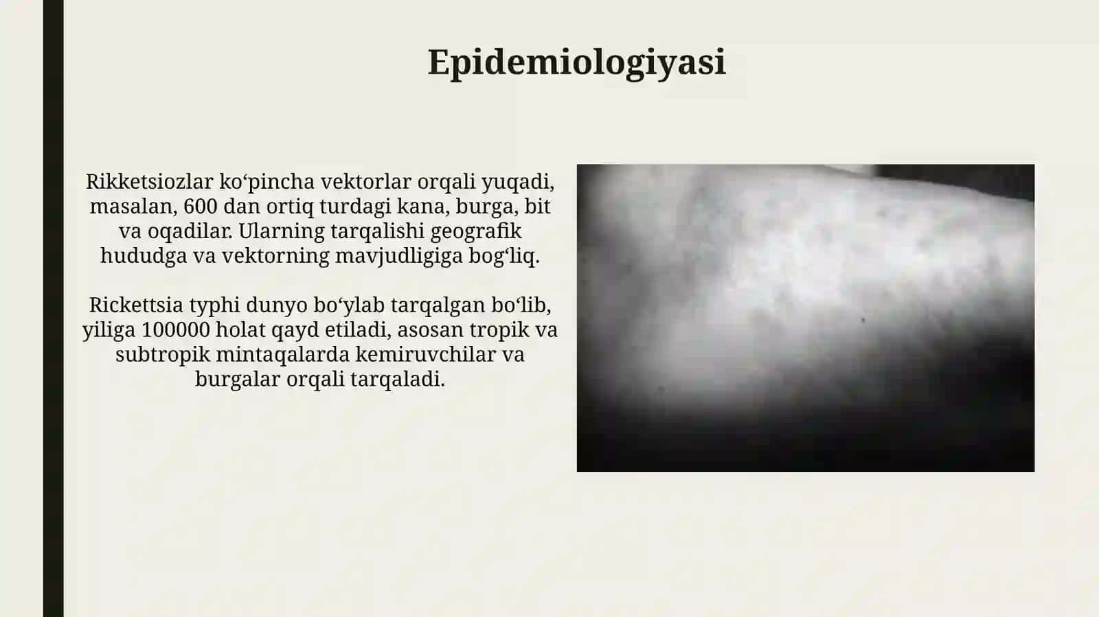 Rikketsiozlar. Etiologiyasi, epidemiologiyasi, klinikasi va davolash 4