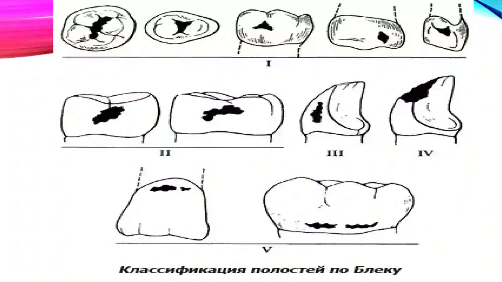 2-SINFKARIOZ KOVAKI BO'SHLIQLARINI CHARXLASH VA PLOMBALASH 4