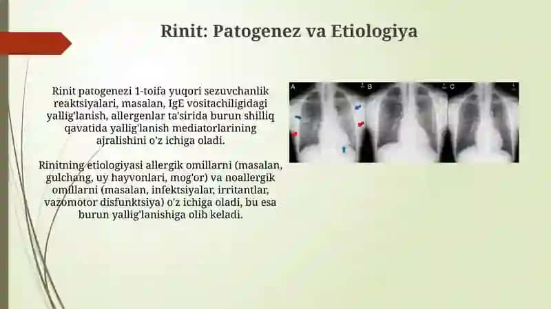 Yuqori nafas yo’llari yallig’lanish kasalliklarida (rinit) F. Yo tamoillari 4