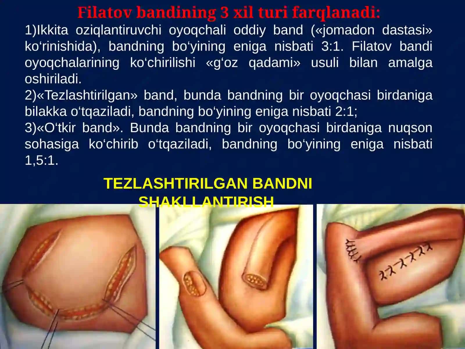 Filatov bandi bilan plastika qilish: Filatov bandini tayyorlashga ko'rsatmalar. Bandni nuqson sohasiga migratsiya qilish bosqichlari. Bandni yoyish. Asoratlar. 4
