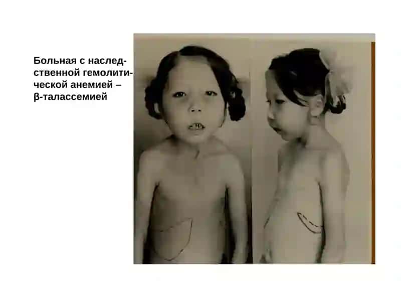 Генеологическая схема семьи с наследственной гемолитической анемией –β-талассемией 4