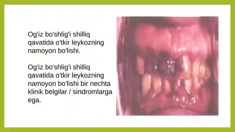 Qon kasalliklarida paradontda sodir boʻladigan oʻzgarishlar 4