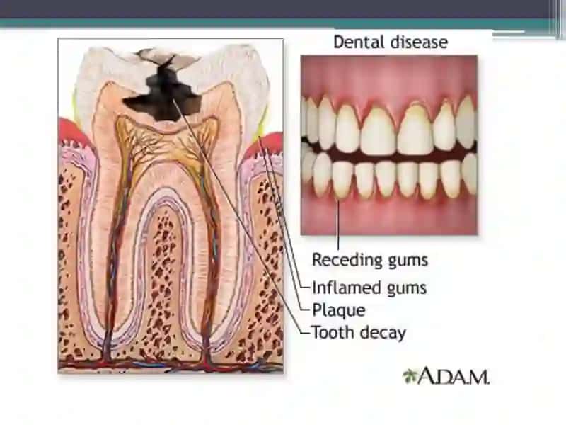 Oral cavity infections 4