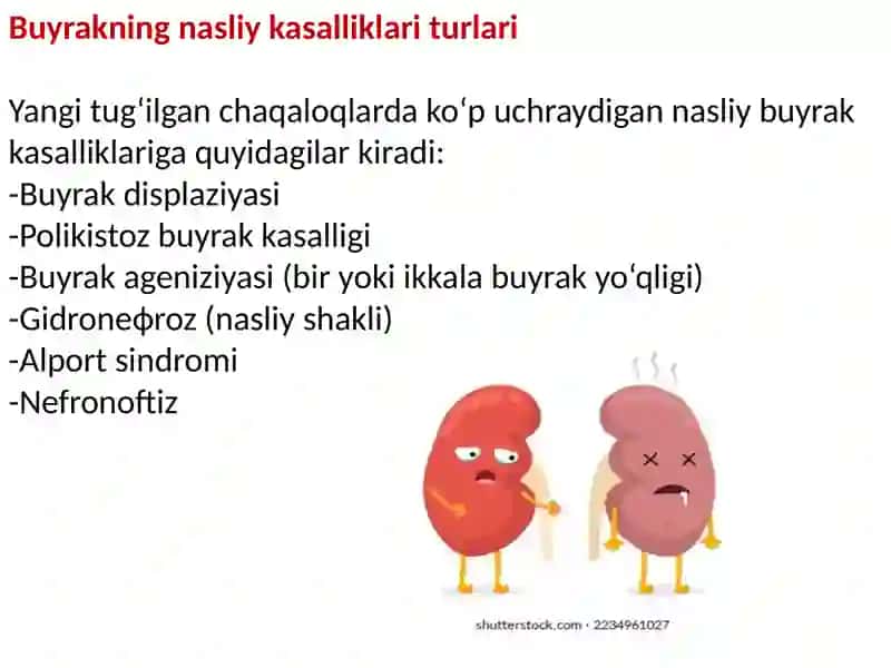 Buyrakni nasliy kasalliklari.Buyrak displaziyasi 4