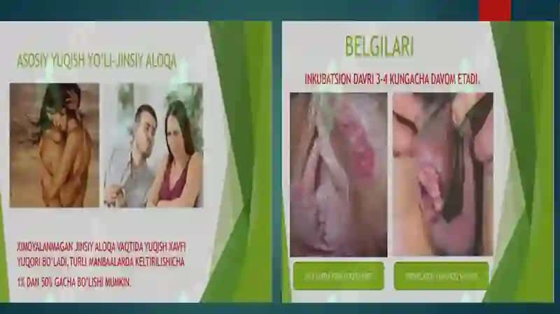 Yumshoq Shankar, Venerik Limfogranulema, Donovanoz, Zahmnining Yomon Sifatli Kechishi Haqida Tushuncha 4