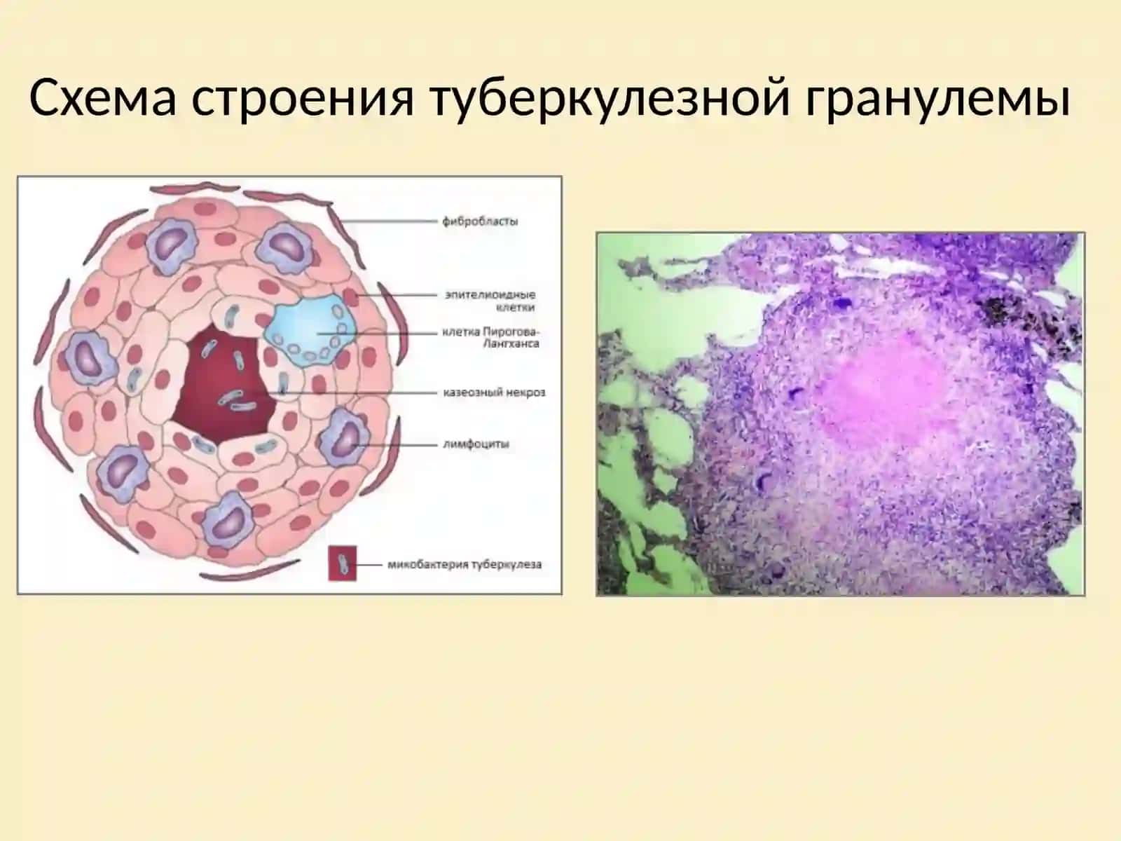 Функциональная морфология лёгких, морфологические проявления туберкулёза лёгких в современных условиях. 4