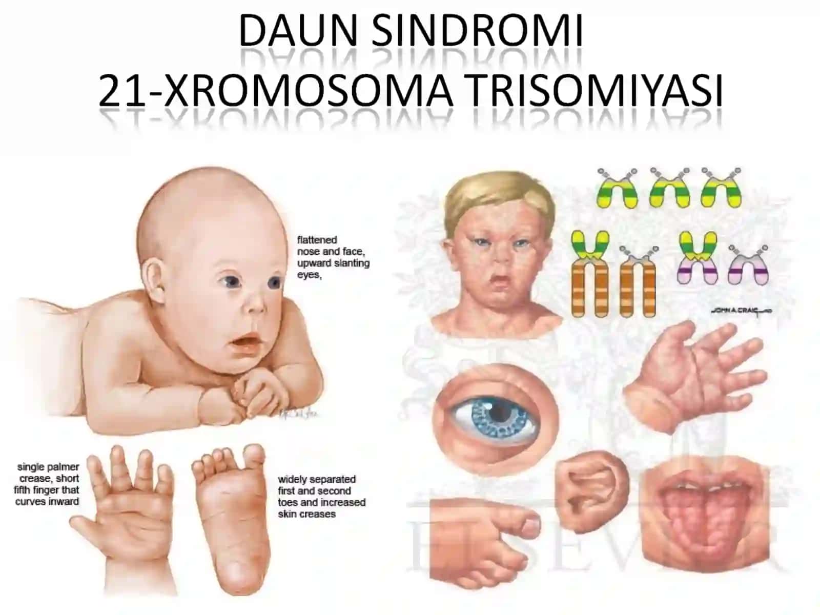 Nerv sistemasi na’sliy kesellikleri tu’rleri 4