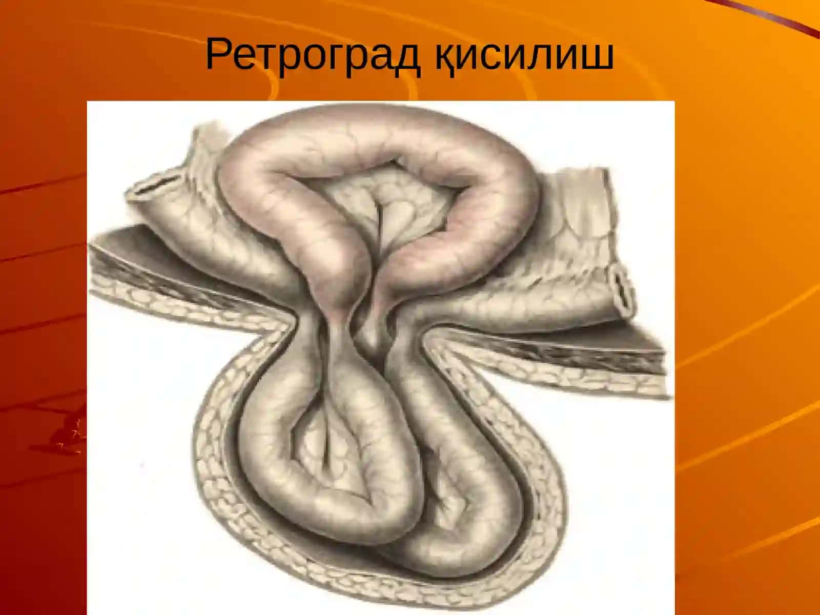Қорин чурраларининг асоратлари 4