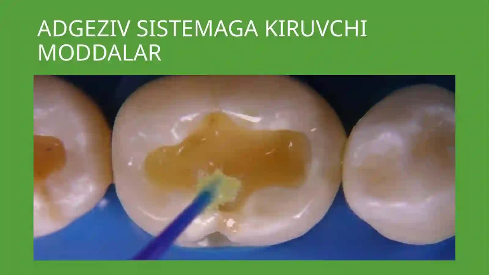 ZAMONAVIY ADGEZIV SISTEMA KILINIK STOMOTOLOGIYADA 4
