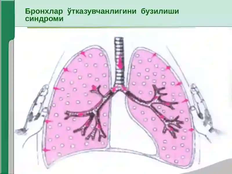 Нафас системаси касалликларида асосий клиник синдромлар 4