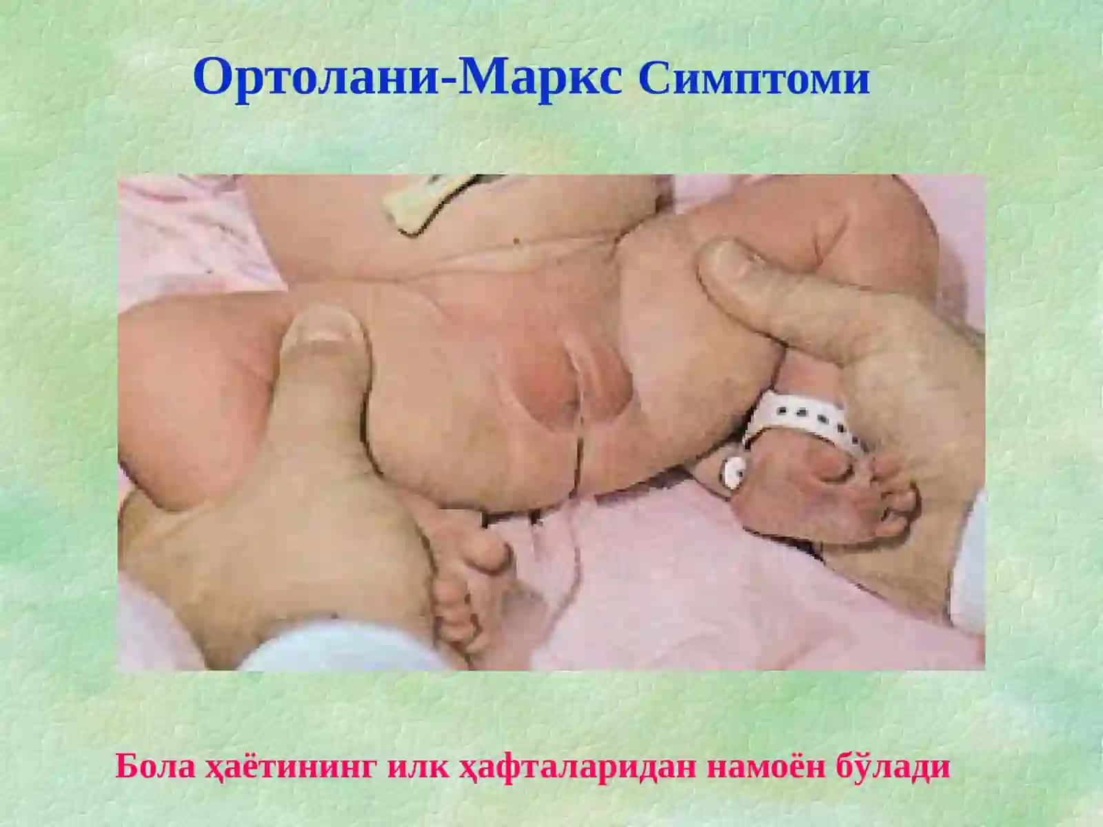 Симптом Барлоу 4