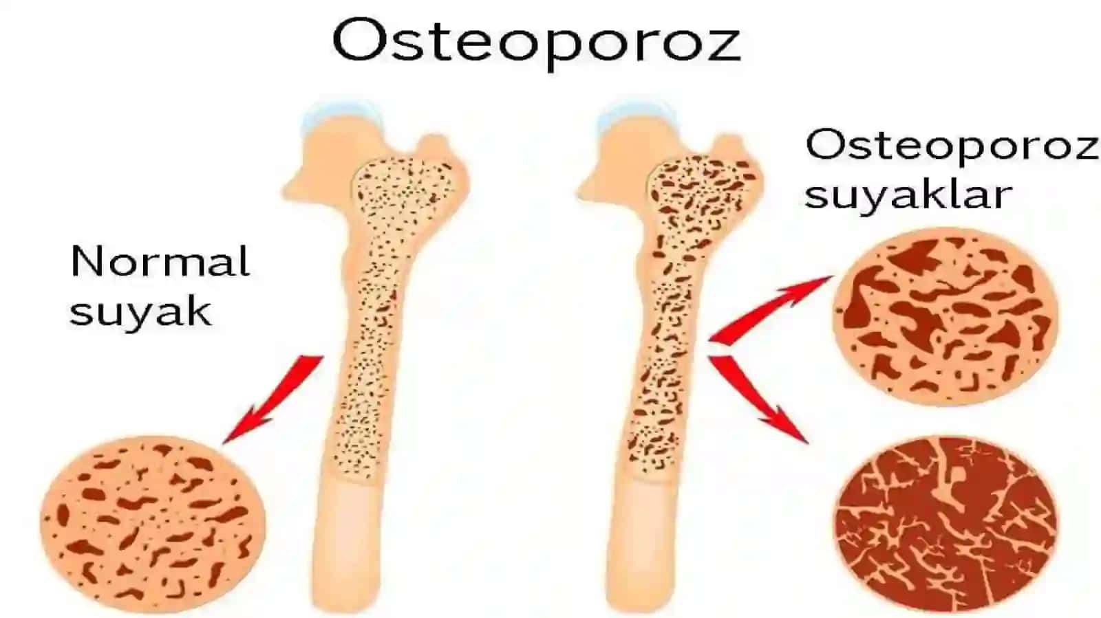 SUYAKLARNI RIVOJLANISHINI BUZILISHLARI. SINISHLAR. OSTEONEKROZ 4