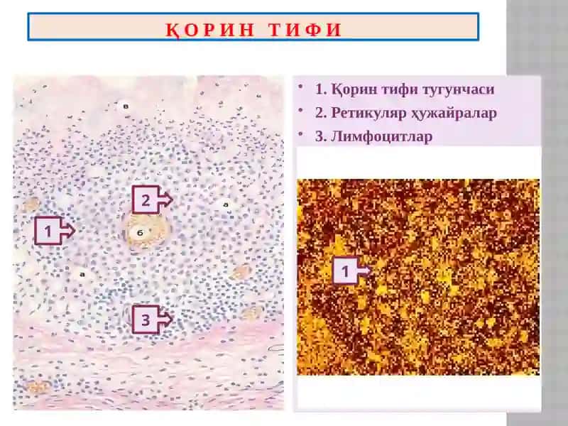 “Ичак инфекциялари” 4