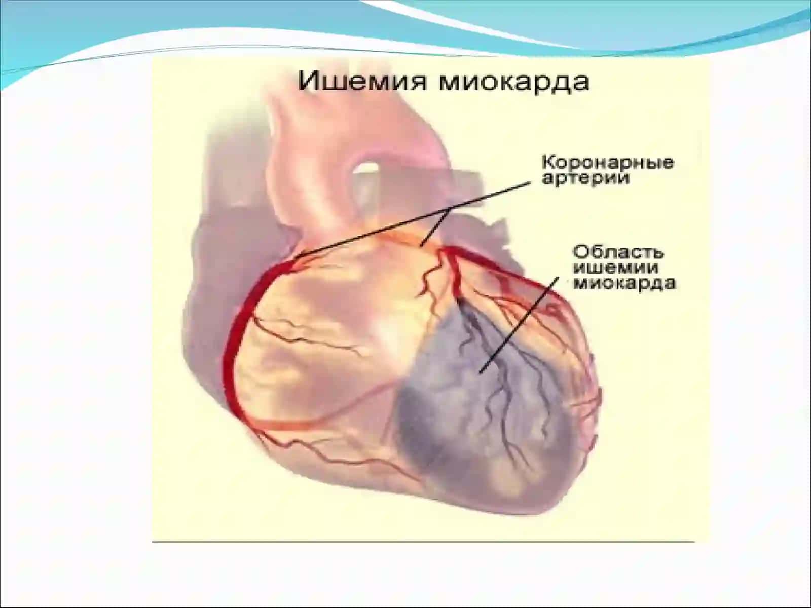Миокард ишемияси ва юрак мушаги некрози синдроми 4