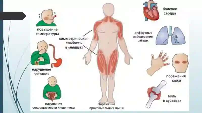 Dermatomiozitlar 4