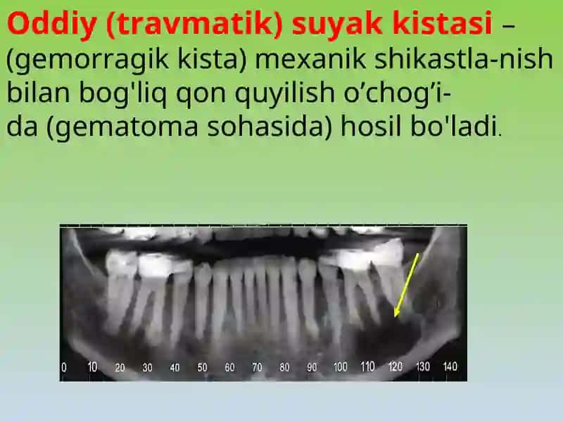 Anevrizmal suyak kistasi 4
