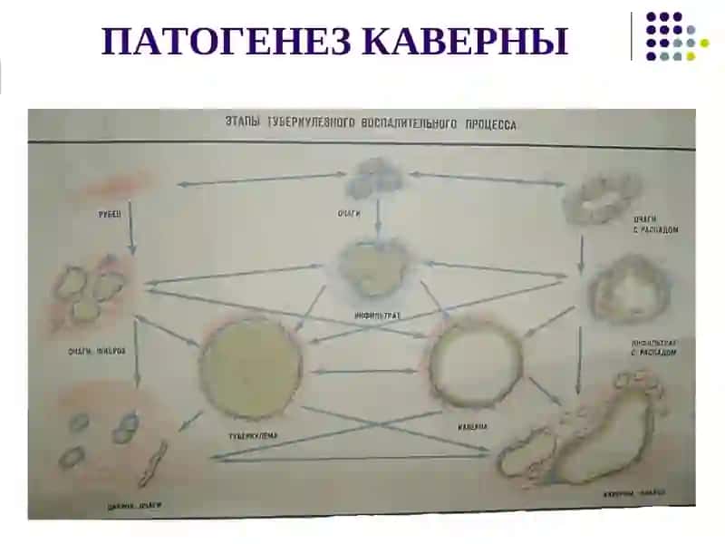 Кавернозный туберкулез 4