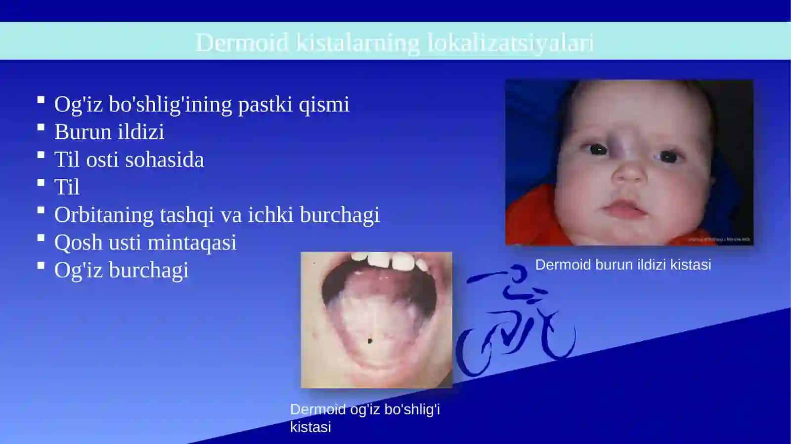Tug‘ma kistalar (Epidermoid va dermoid kistalar, yuz va bo‘yin kistalar hamda oqma yo‘llari) 4
