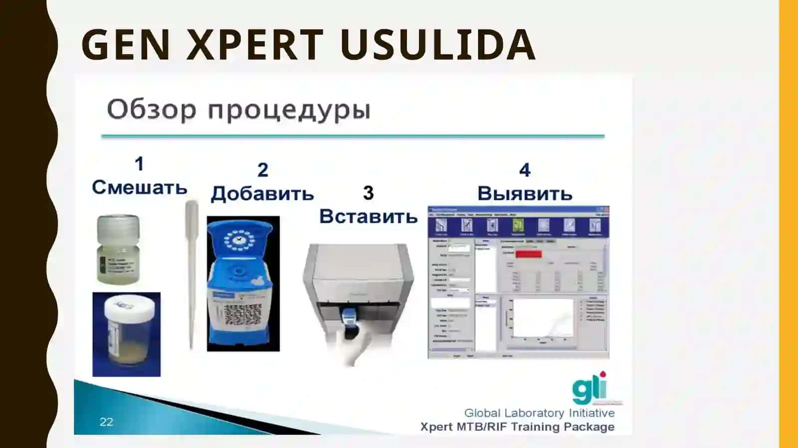 Tuberkulyoz Diagnostikasi: Ob’ektiv va Klinikolaborator Tekshirish Usullari 4