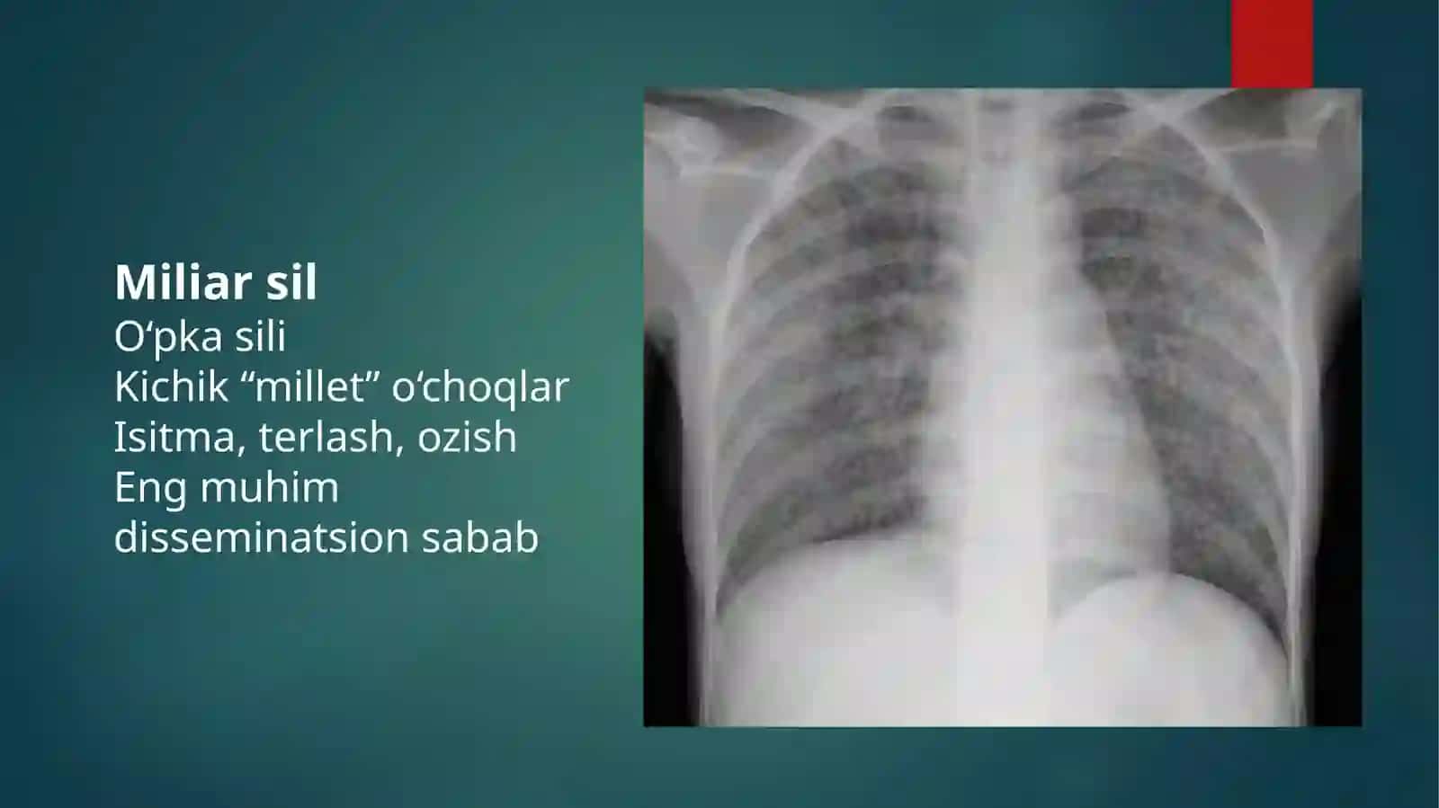 O‘pka disseminatsiyasini qiyosiy tashxislash 4