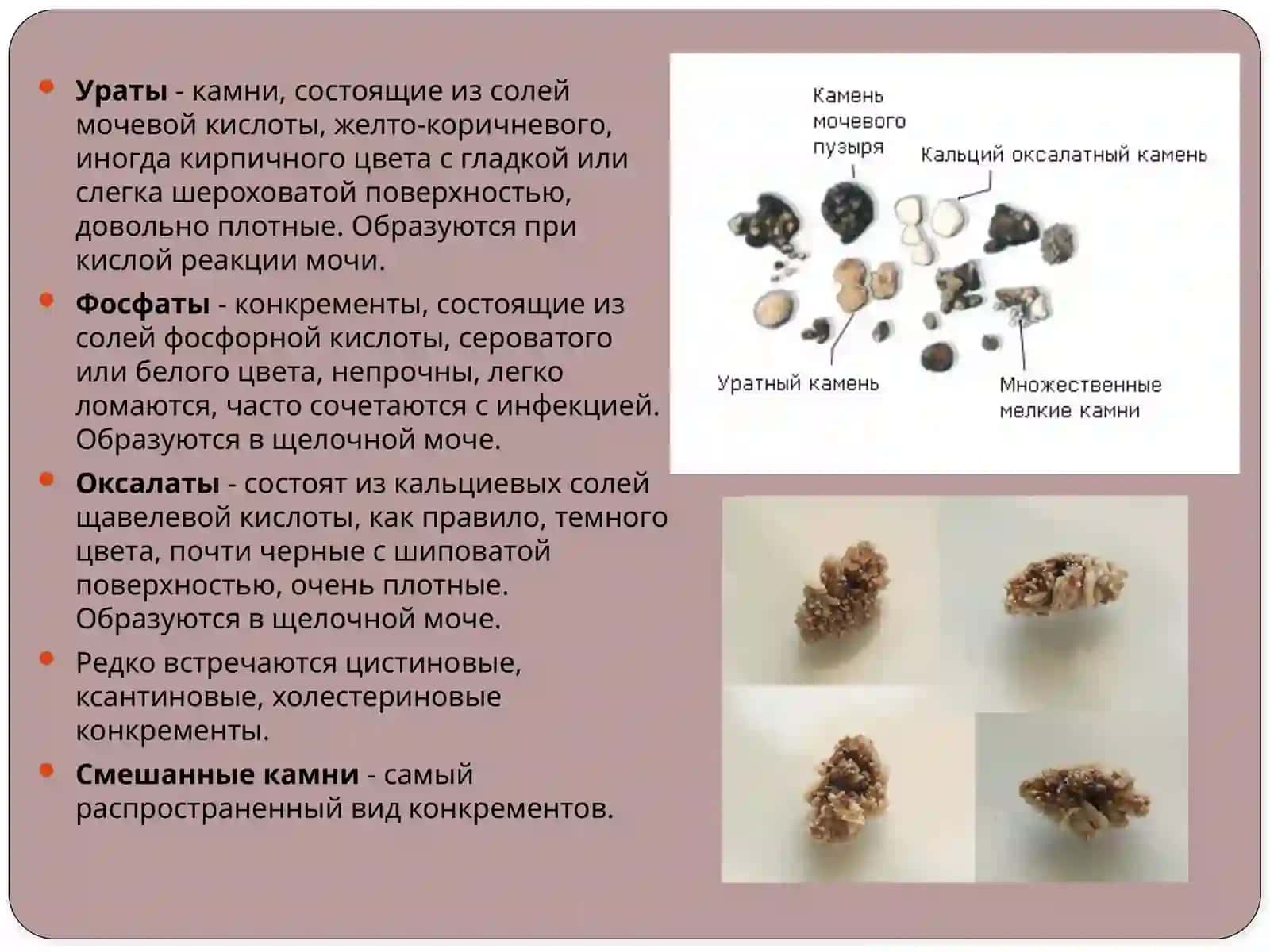Мочекаменная болезнь 4