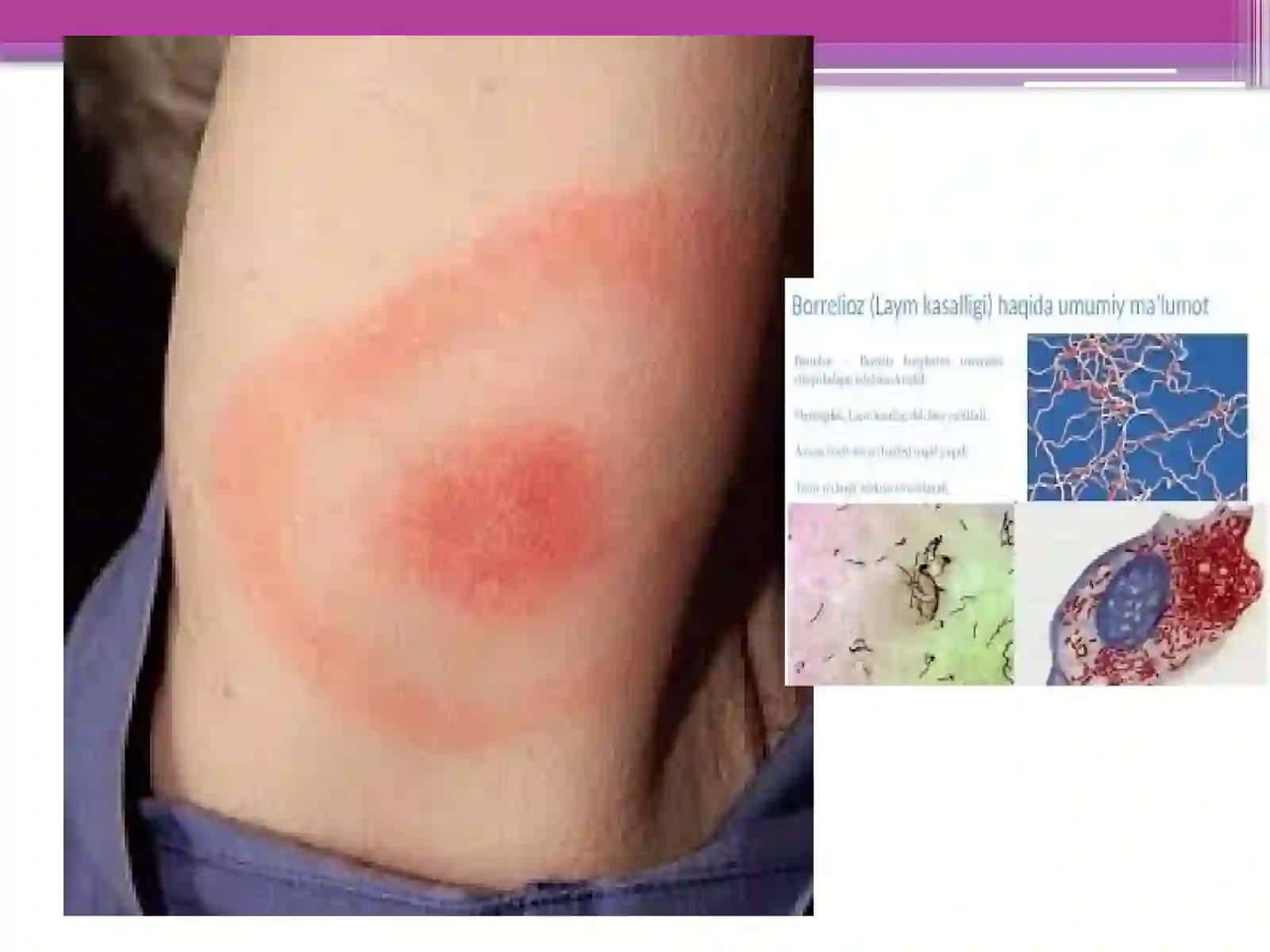 Borrelioz(laymakasalligi)Leotospiralarmarfologiyasi,strukturasi,tarqalishi,keltiribchiqaradigankasalliklarivalabaratoriyatashxisi 4