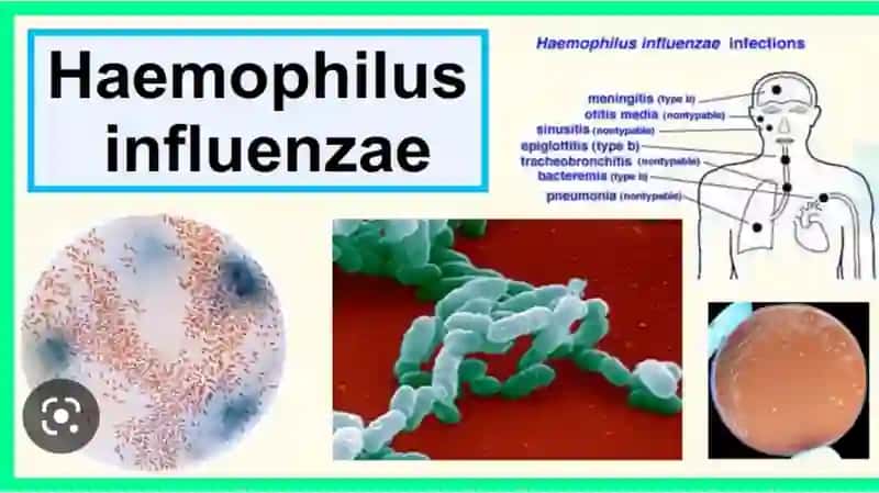 Inflyuens qo'zg'atuvchisi (Haemophilus influenzae) 4