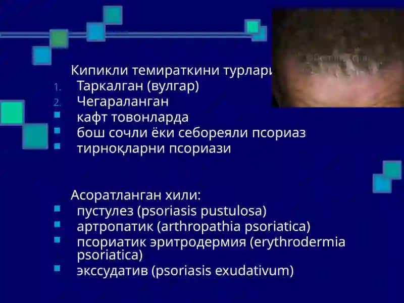 Псориаз 4