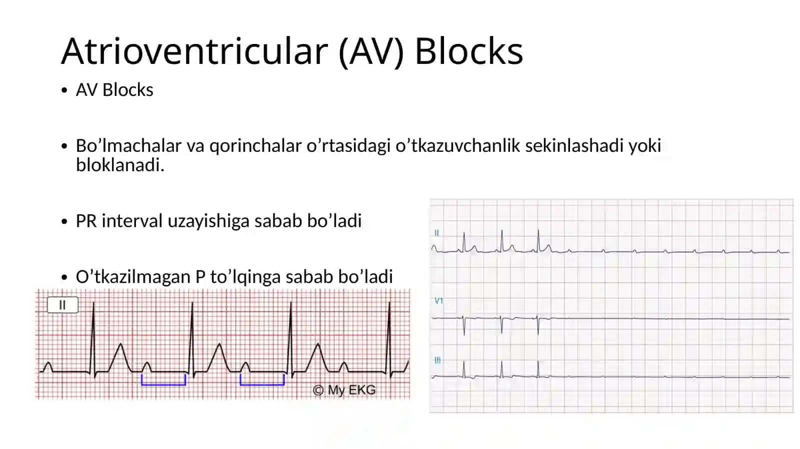 Yurak ritm buzilishi. Yurak o‘tkazuvchanligining buzilishi: Blokadalar. 4