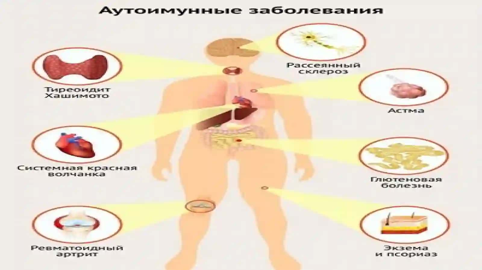 Autoimmun va allergik kasalliklar kelib chiqishi,kechishi,diagnostikasi 4