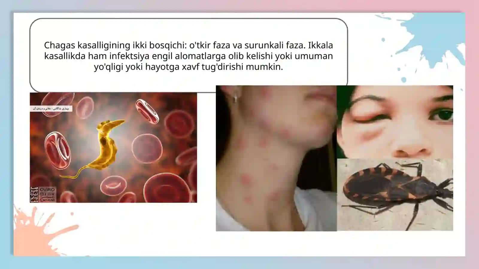 Chagas kasalligi - Trypanosoma cruzi (T. cruzi) parazitidan kelib chiqqan yuqumli kasallik 4