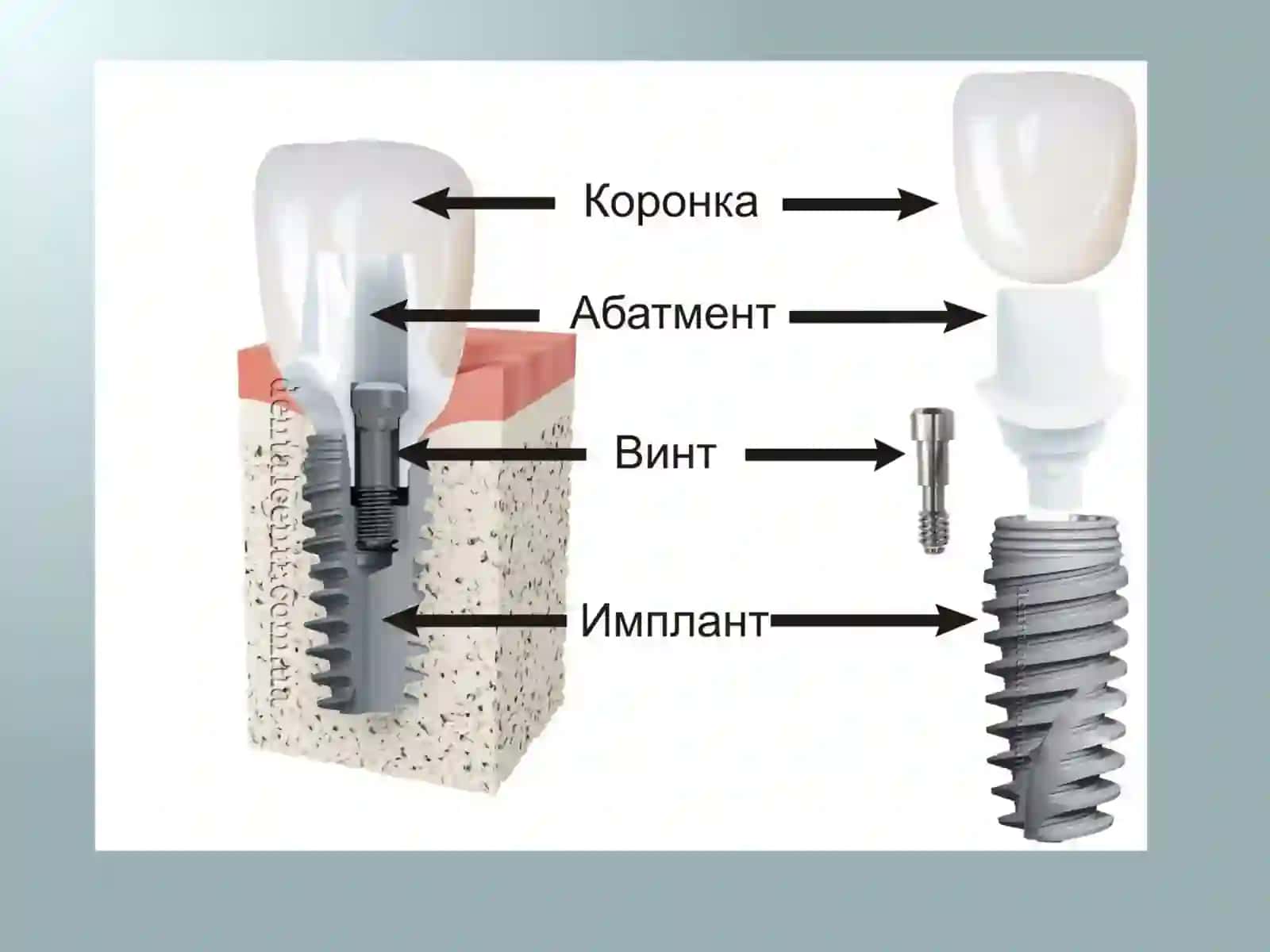 Implant asosidagi protezlar 4