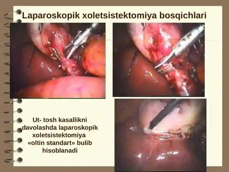 SOMATONEVROLOGIK SINDROMLAR (JIGAR,BUYRAKVA O’PKA KASALIKLAR) 4