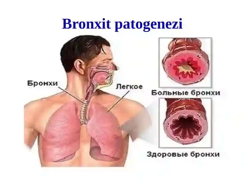 Bronxlar o‘tkazuvchanligini buzilishi sindromi. O‘tkir va surunkali bronxitlar simptomatologiyasi 4