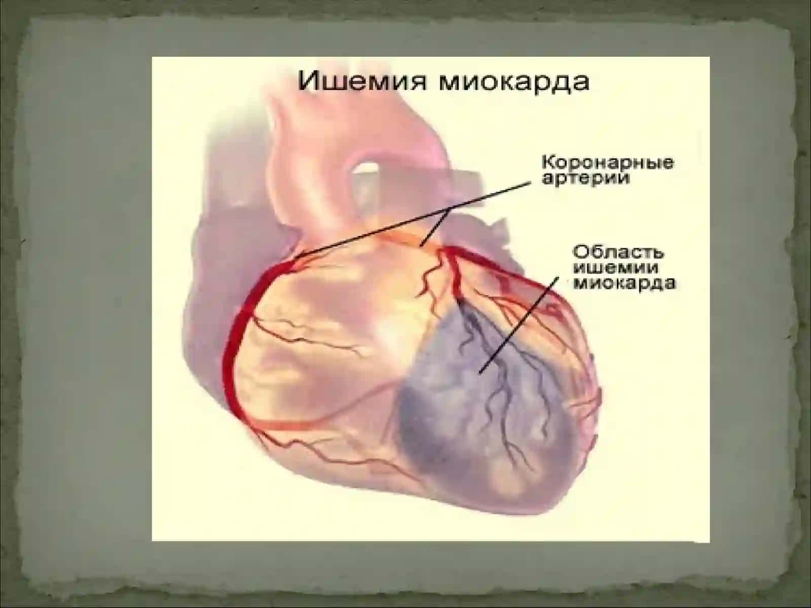 Миокард ишемияси ва юрак мушаги некрози синдроми 4