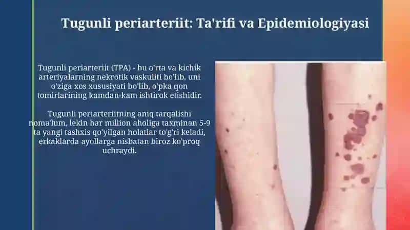 Tugunchali periartrit,nospetsifik aortaartrit kasalliklari diagnostikasi 4
