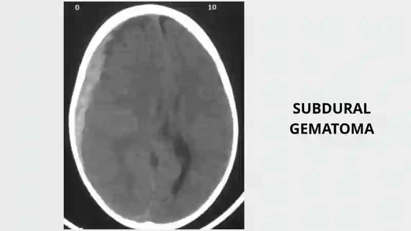 Subdural Gematoma 4