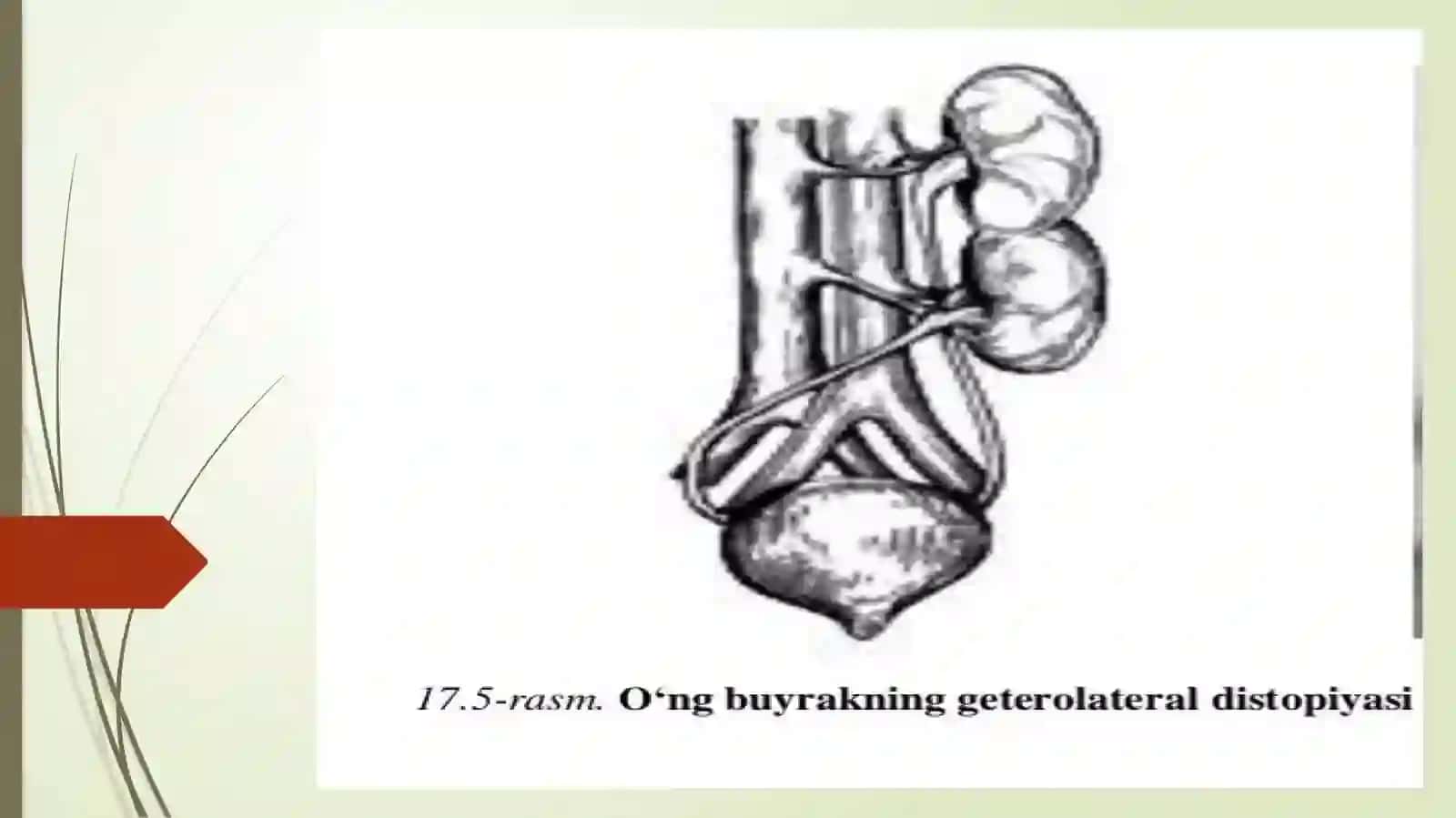 BUYRAKLARNING TUG’MA VA ORTTIRILGAN DISTOPIYASI,TAQASIMON BUYRAK VA ULARNI OPERATIV DAVOLASH USLUBLARI 4