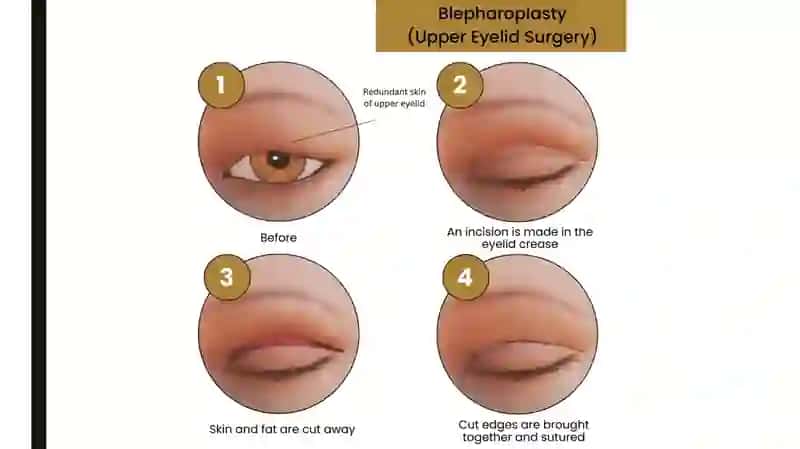 Yuzdagi plastik operasiyalar (blefaroplastika) 4